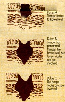 Esquema de Dukes