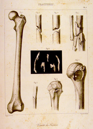 Lámina del Atlas de Malgaigne